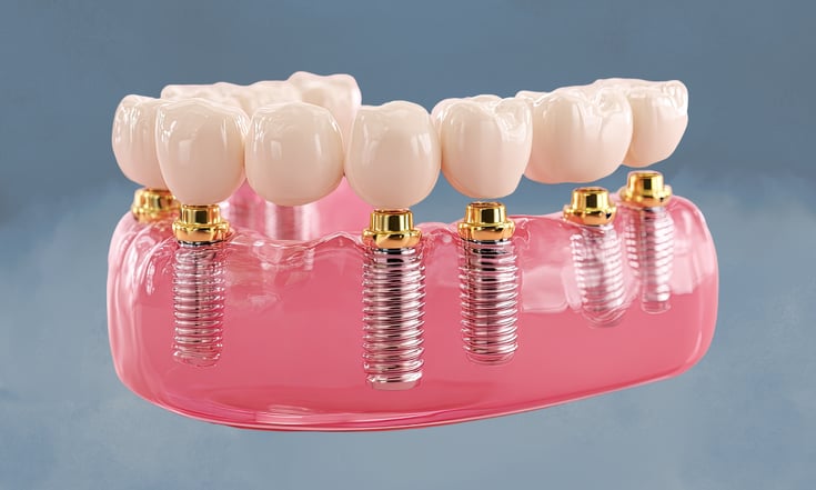 Case Scenarios That Benefit Most from Digital Implant Design